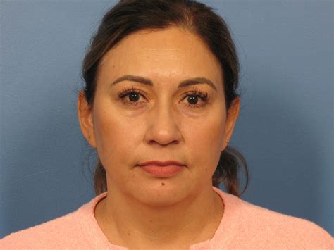 Case 1022 | Upper Eyelid Lift Before & After Photos