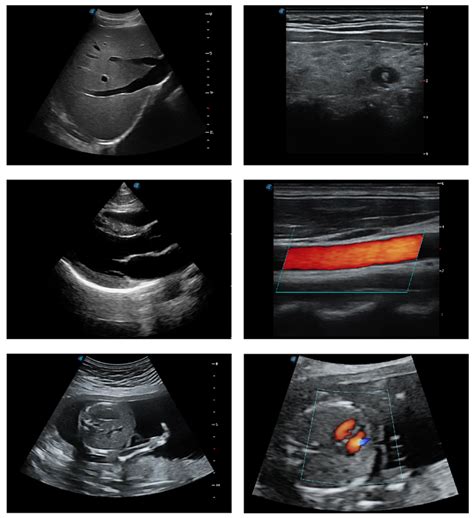 Ultrassom Ecocardiógrafo Fixo P20 Sonoscape