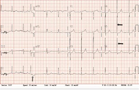 Electrocardiogram Showing Premature Ventricular Contractions Blue