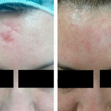 ematrix  skin resurfacing