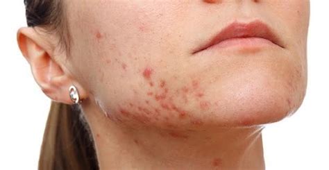 Espinhas Na Região Do Queixo - Espinhas No Queixo E Pescoço: O Que Fazer Para Resolver Este Problema