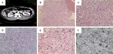 Figure 1 From Clinicopathologic Features Of Renal Epithelioid