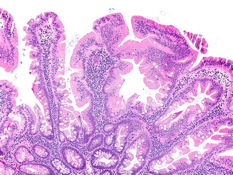 Sessile Polyp Histology