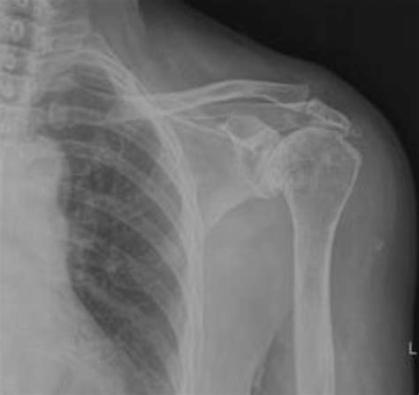 Osteoarthritis X Ray Shoulder