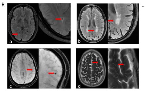 Total Burden of Cerebral Small Vessel Disease on MRI May Predict