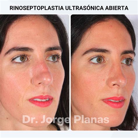 Rinoplastia Ultrasónica Antes Y Después Resultados Espectaculares