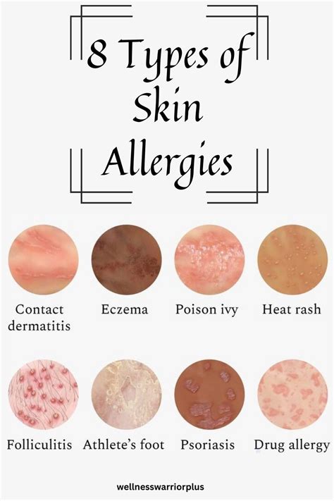 8 Types Of Skin Allergies In 2024 Skin Allergies Allergies Skin Rash