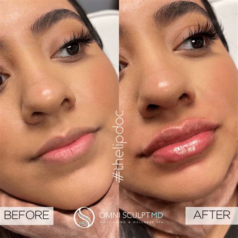 Lip Injection Before After Gallery OMNI SCULPT MD