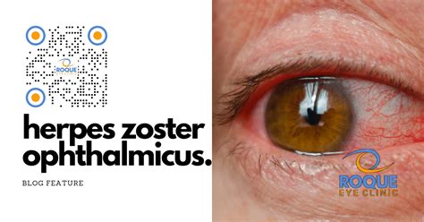 Understanding Herpes Zoster Ophthalmicus Symptoms Treatment And