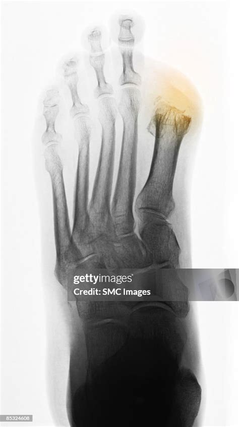 xray diabetic foot  toe amputations high res stock photo getty images