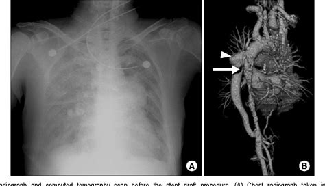 Figure 1 From Endovascular Rescue Of A Narrowed Aorto Aortic Bypass