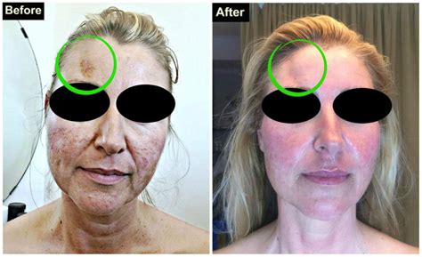 Our 5-Stage Face Lifting Treatment Can Correct The Physical Appearance ...