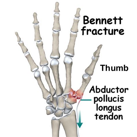 Bennett fracture,what to know?