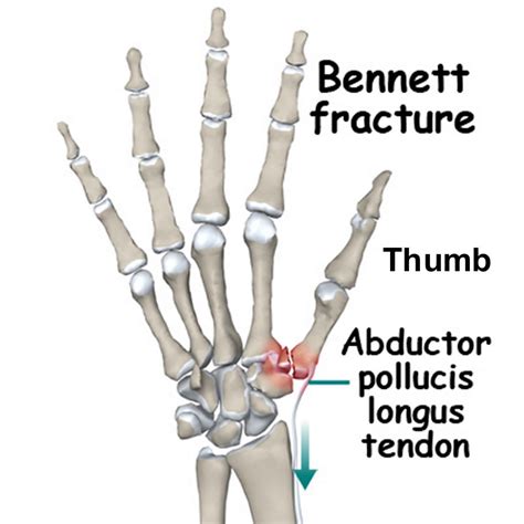 Bennett fracture causes, symptoms, diagnosis, treatment & prognosis