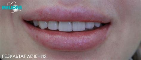 Керамические накладки на зубы - результат лечения