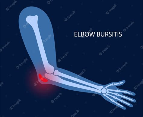 Premium Vector Student Elbow Bursitis