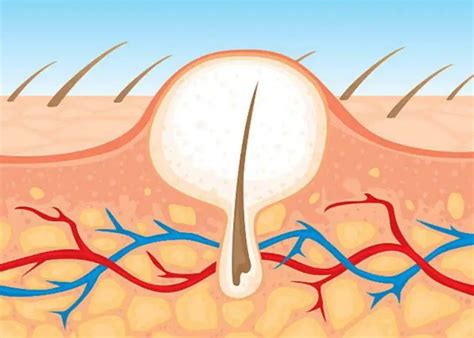 Ingrown Hair On Scalp Head With Cyst Bump Causes And Removal Treat N Heal