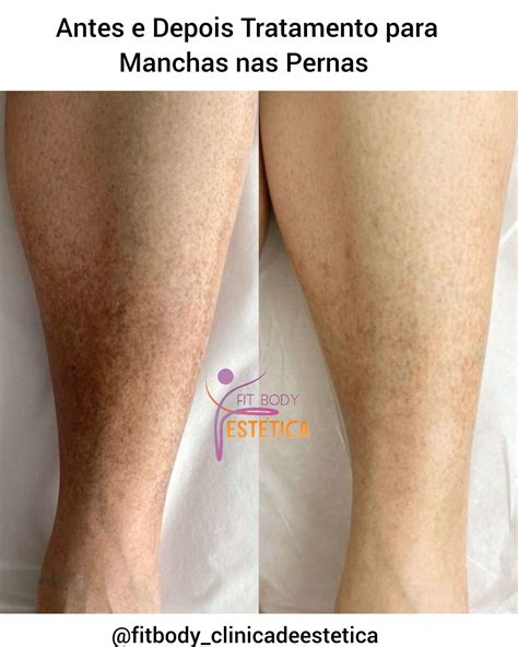 Manchas Na Perna O Que Pode Ser