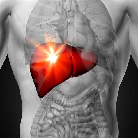 Acute Liver Failure Symptoms Causes And Natural Treatment Options