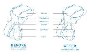 How Soon After A Vasectomy Can You Have Sex Direct Access Vasectomy