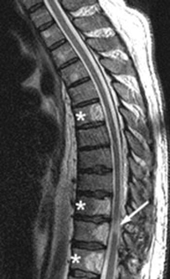 HEMANGIOMA SPINE MRI T1 T2 - Wroc?awski Informator Internetowy - Wroc ...