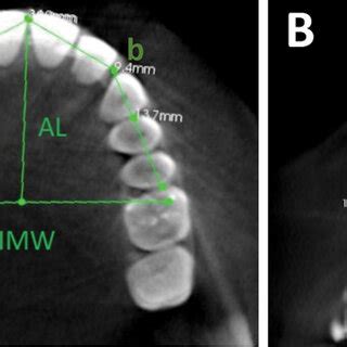 representation   measurements   intermolar width imw