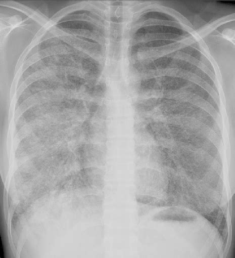 Chest X Ray Posteroanterior View Shows Bilateral Diffuse Micronodular