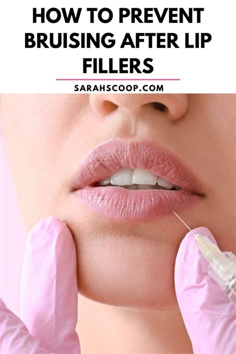 How To Prevent Bruising After Lip Fillers Sarah Scoop