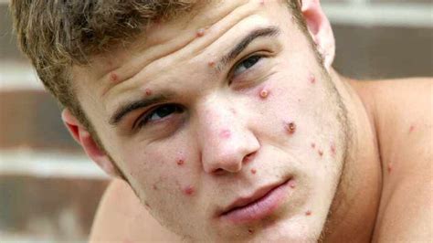 Monkeypox Who Advises Gay Men To Limit Number Of Partners