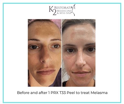 Prx T33 Non Peeling Biorevitalization Peel Birmingham Al