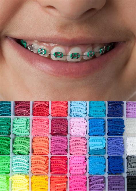 Coloured Braces Quayside Orthodontics