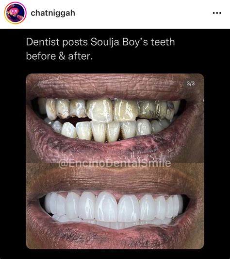 Dentist Reveals Soulja Boy Teeth Before And After Cwbritish Teeth Itt