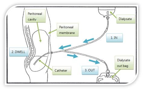 Peritoneal Dialysis Slide Show On Emaze