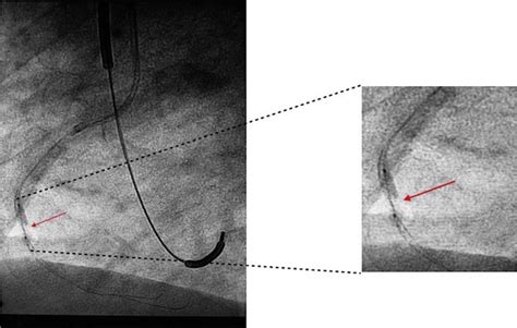 A Calcific Undilatable Stenosis Lithoplasty A New Tool In The Box