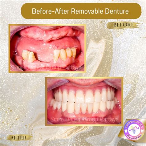 Dentures En Central Pattaya Dental Center