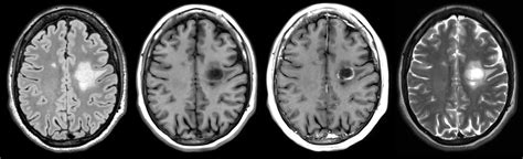 MRI Gadolinium-Enhancing Lesions in MS Clinical Trials