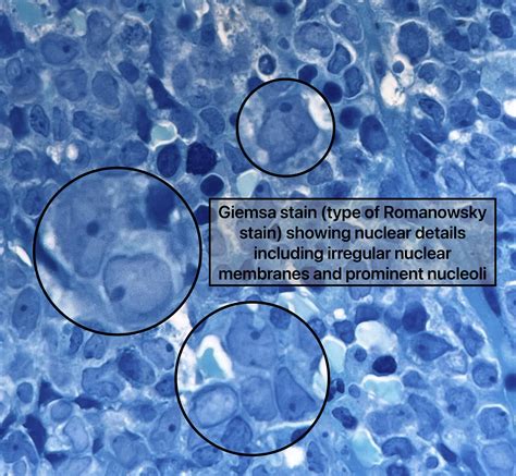 Morphologic features of Acute Lymphoblastic Leukemia (B-ALL) involving