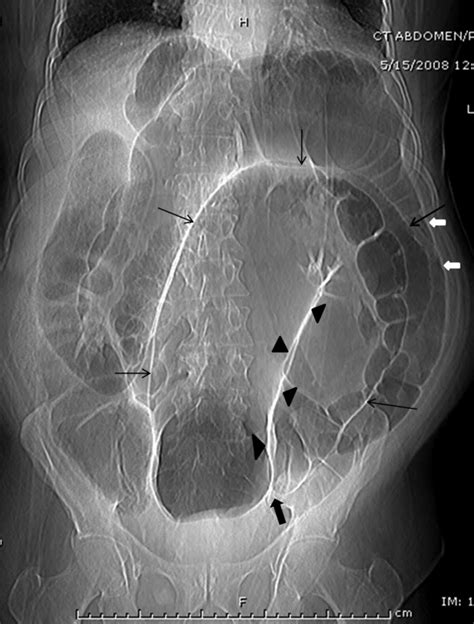 Sigmoid Volvulus Mdedge