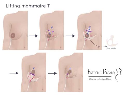 Lifting mammaire Cure de ptôse mammaire à Paris