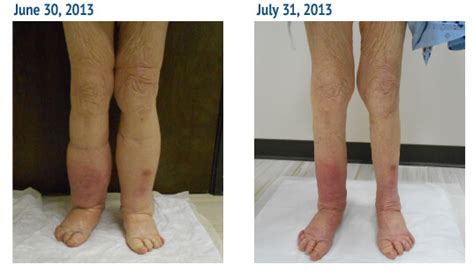 Lymphedema Treatment