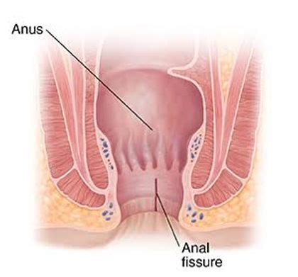 Anal Fissure