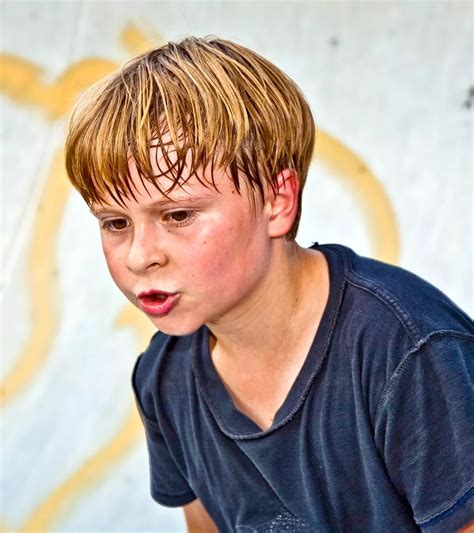 Rosacea In Children Causes Symptoms Treatment And Prevention