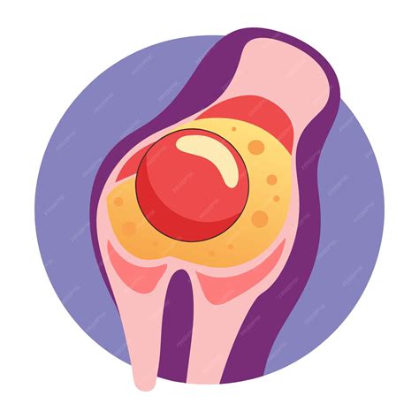 Bakers Cyst in the Knee clip art and vector design with a white