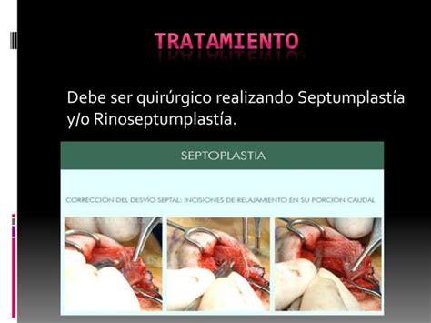 Rinitis por desviación del septum nasal PPT Descarga Gratuita