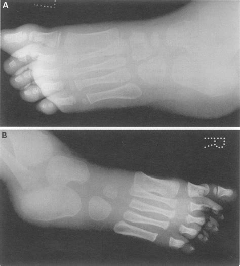 Transverse Fracture Of The Proximal Phalanx Of The Great Download