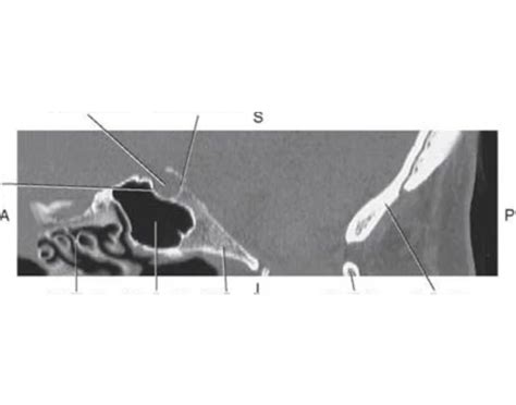 Fig 219 Sagittal Ct Of Sella Turcica Quiz