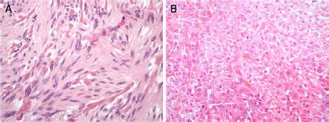 GIST Spindle A And Epithelioid B Morphology HE 400X Pathology