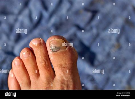 Fingernail With Bruises Injured Thumb On Leg Blood Clot Underneath