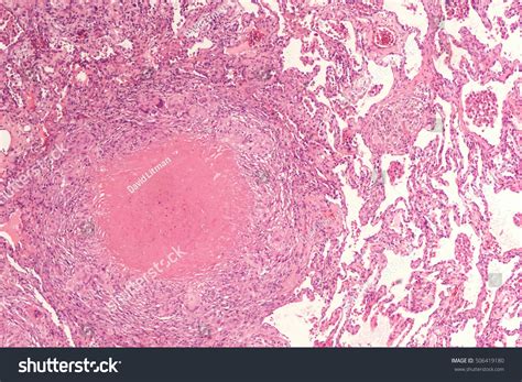 79 Caseous Necrosis Images Stock Photos And Vectors Shutterstock