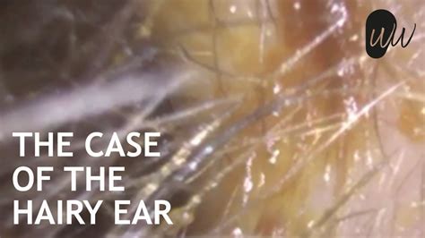 Ear Wax Removal Of Matted Hairy Ear Wax Off Ear Canal Eardrum 377